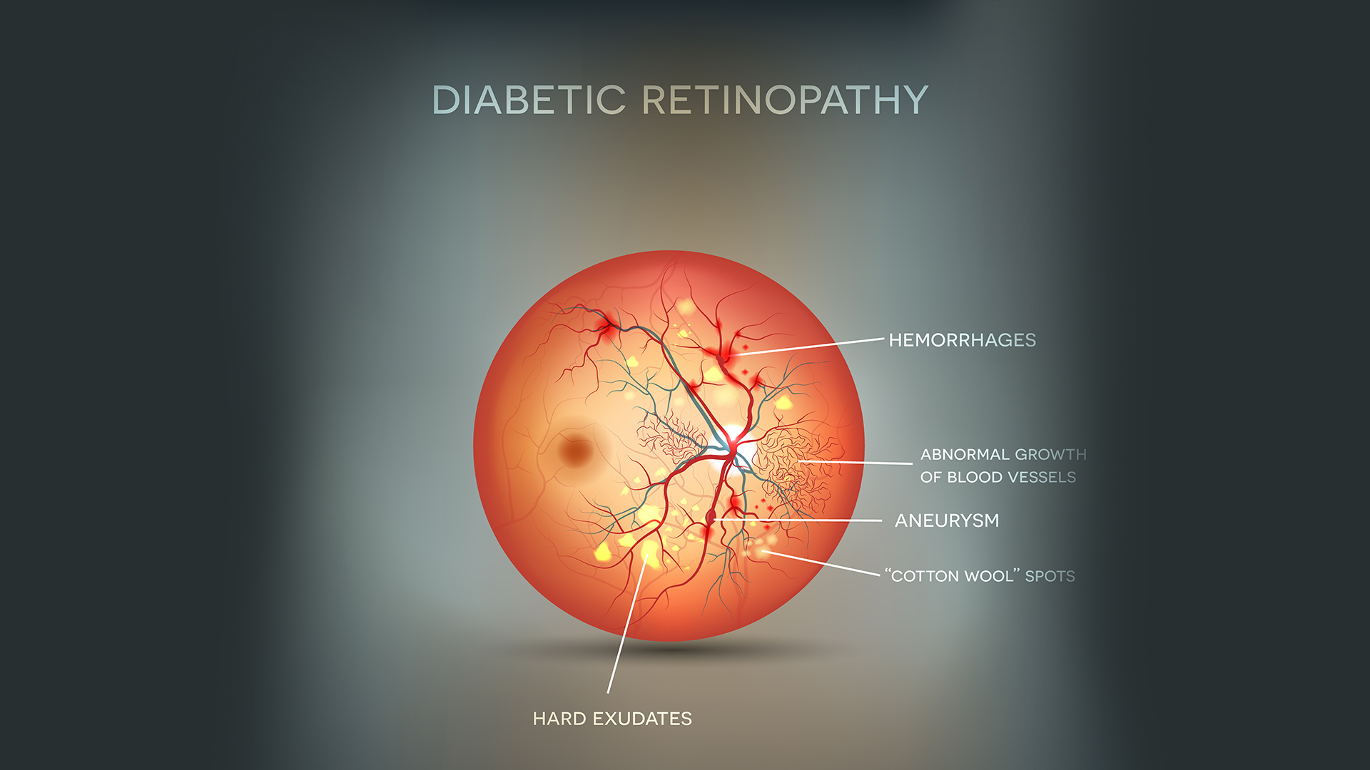 Détection de la Rétinopathie Diabétique avec EfficientNet
